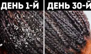 ТОП-10 бюджетных рецептов от перхоти в домашних условиях для здоровья волос
