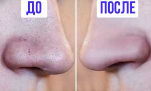 Как избавиться от черных точек на лице: ВИДЕО – рецепты и советы