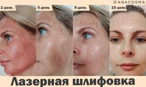 Лазерный пилинг для лица: виды процедуры и как проходит восстановление, полезные советы