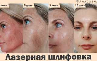 Лазерный пилинг для лица: виды процедуры и как проходит восстановление, полезные советы