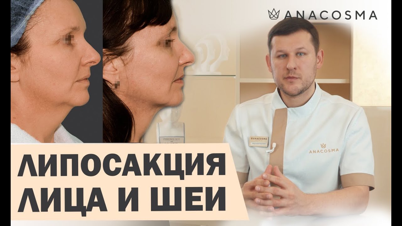 Липосакция лица, щек и второго подбородка