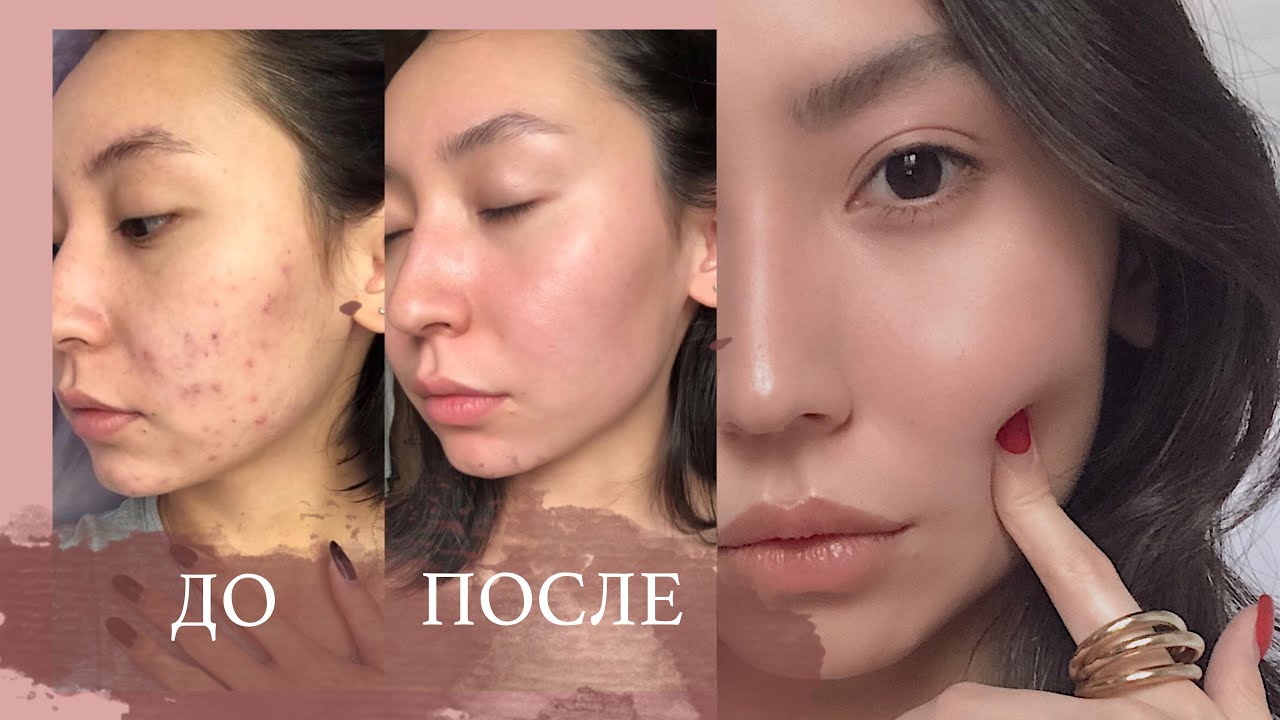 Как избавиться от постакне?