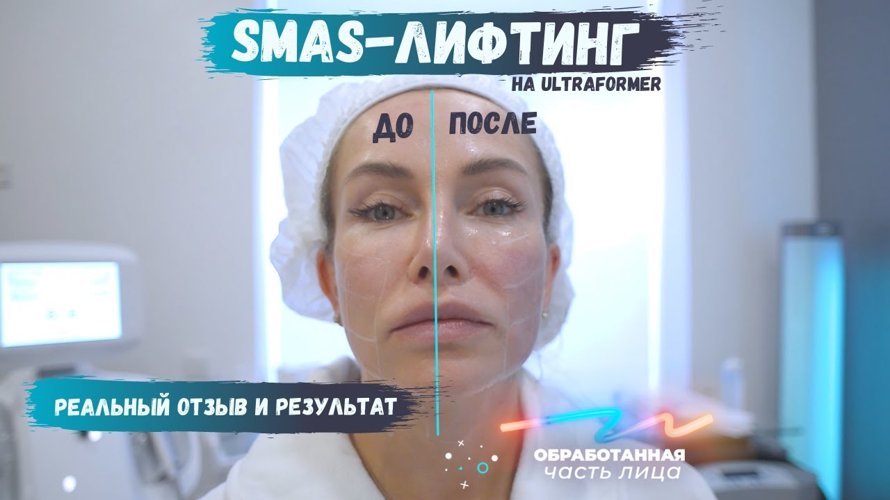 Smas-лифтинг на ULTRAFORMER