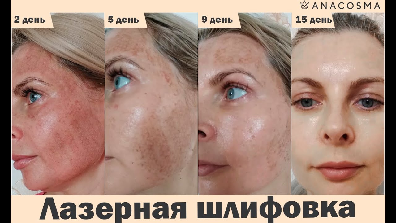 Лазерная шлифовка лица: до и после
