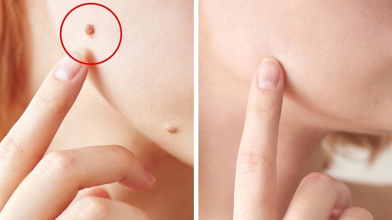 Как избавиться от папиллом?
