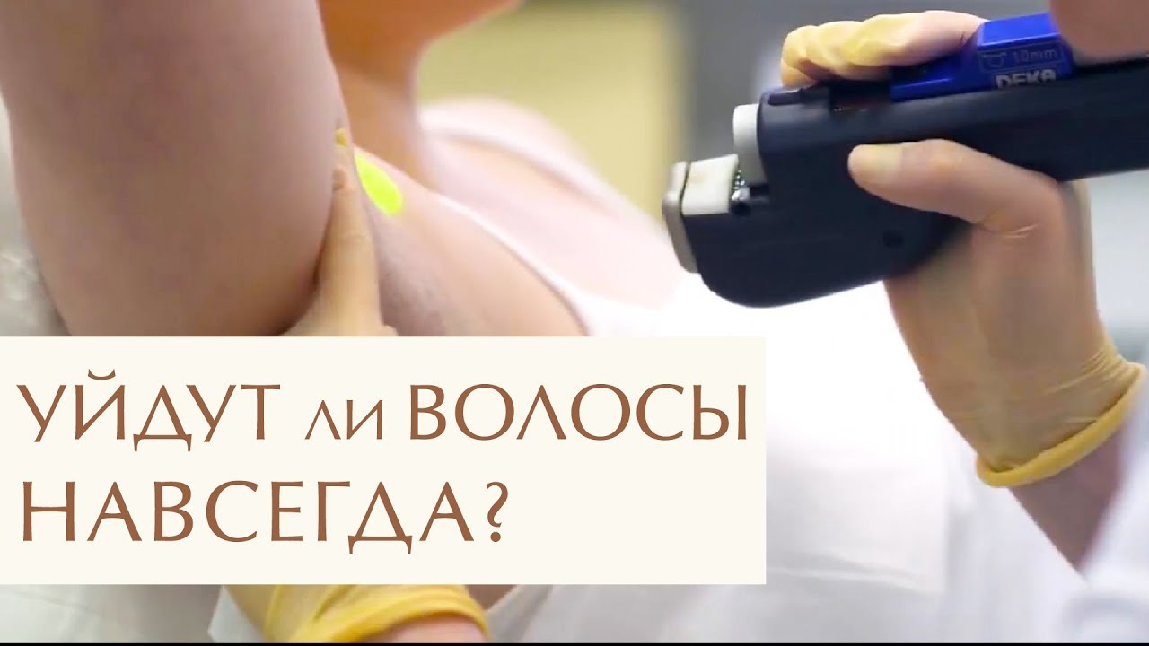 Все о процедуре лазерной эпиляции