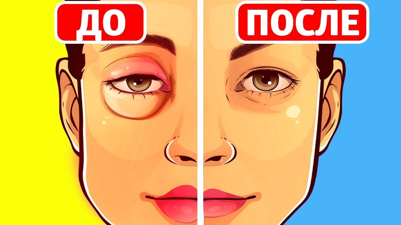 Как убрать отек лица за 5 минут?