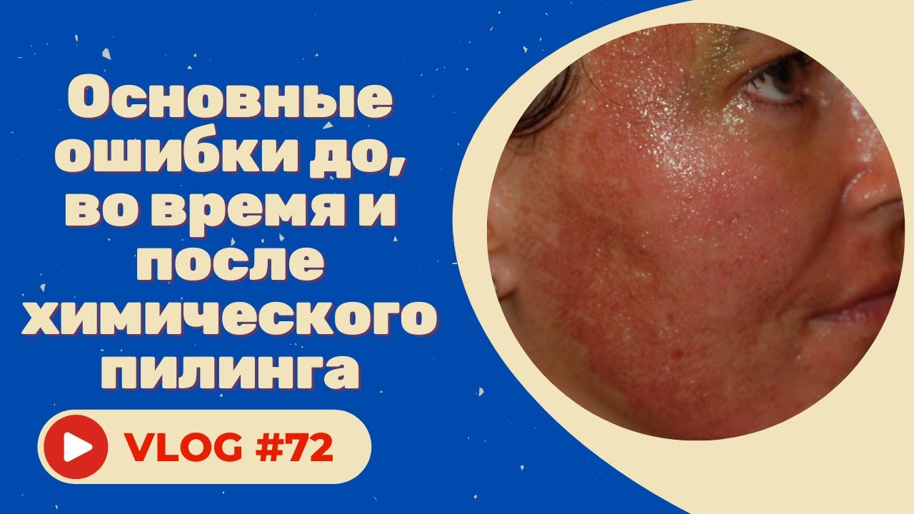Ошибки до, во время и после химического пилинга