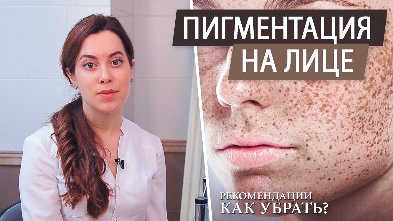 Гиперпигментация лица