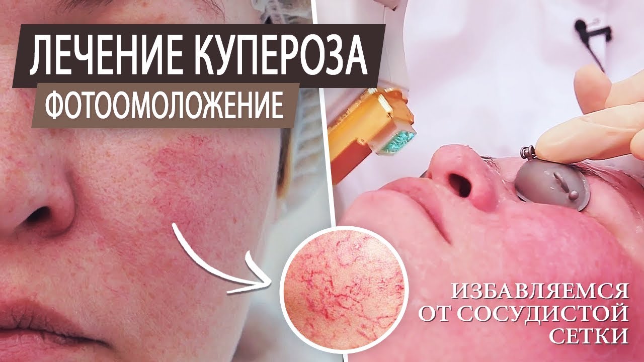 Лечение купероза. Фотоомоложение. 