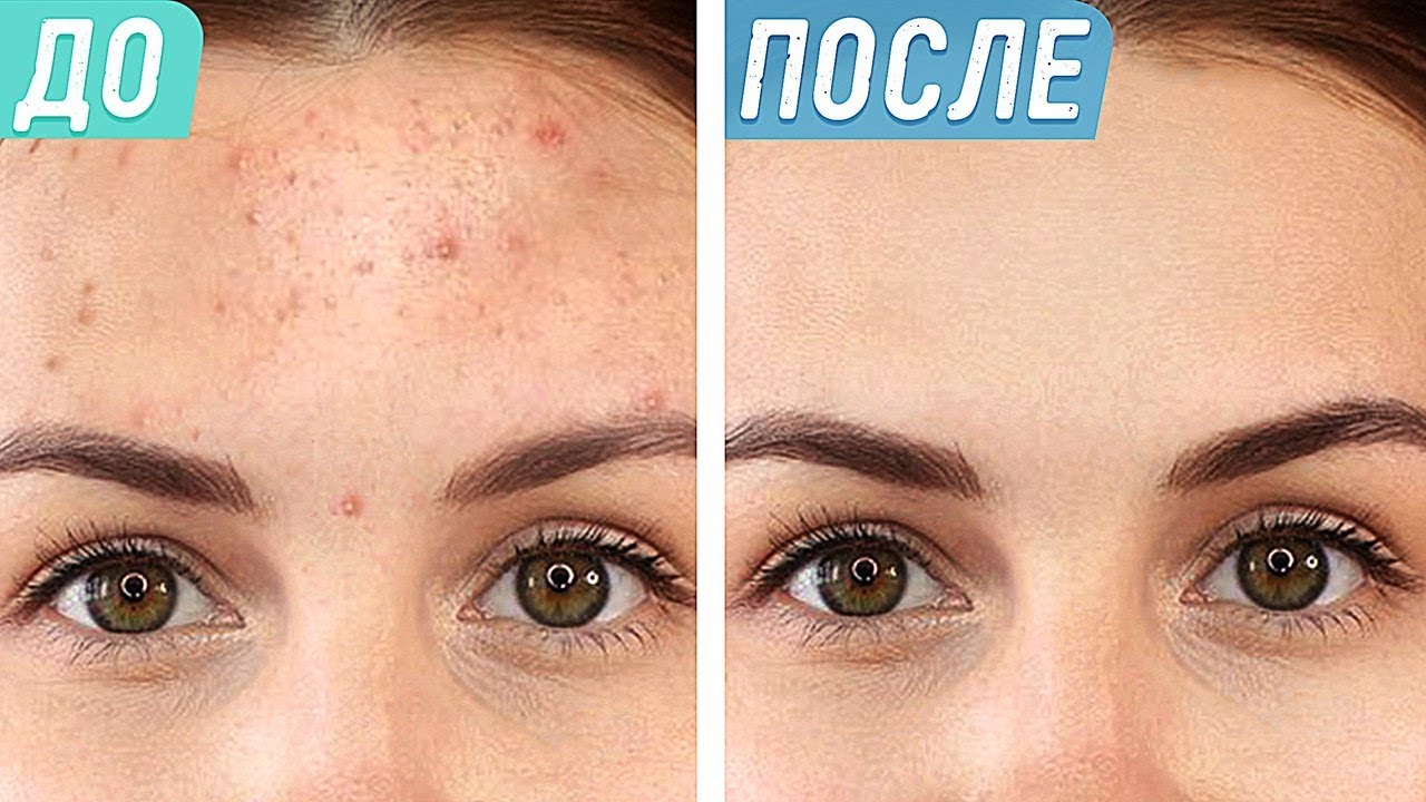 5 крутых способов избавиться от прыщей