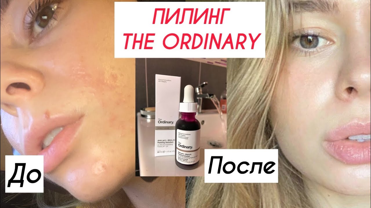 Что такое кровавый пилинг?