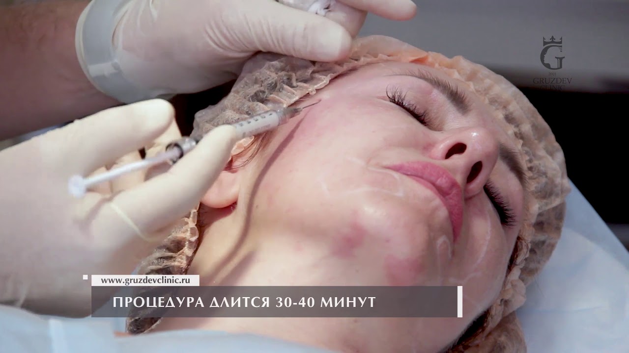 Что лучше для лифтинга: филлеры или жидкие нити?