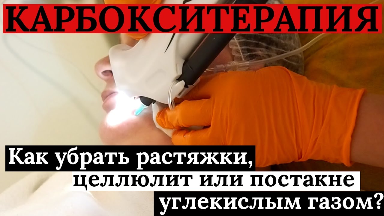 Карбокситерапия – как происходит процедура?