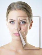 Как избавиться от следов после прыщей на лице? Как избавиться от следов после прыщей на лице?