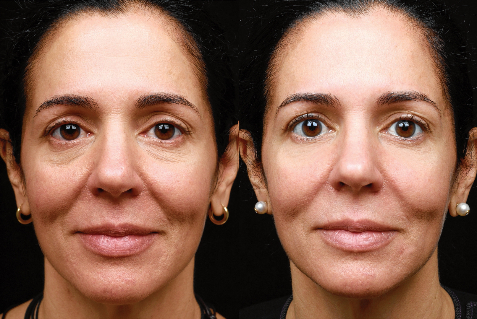 Радиолифтинг лица до и после