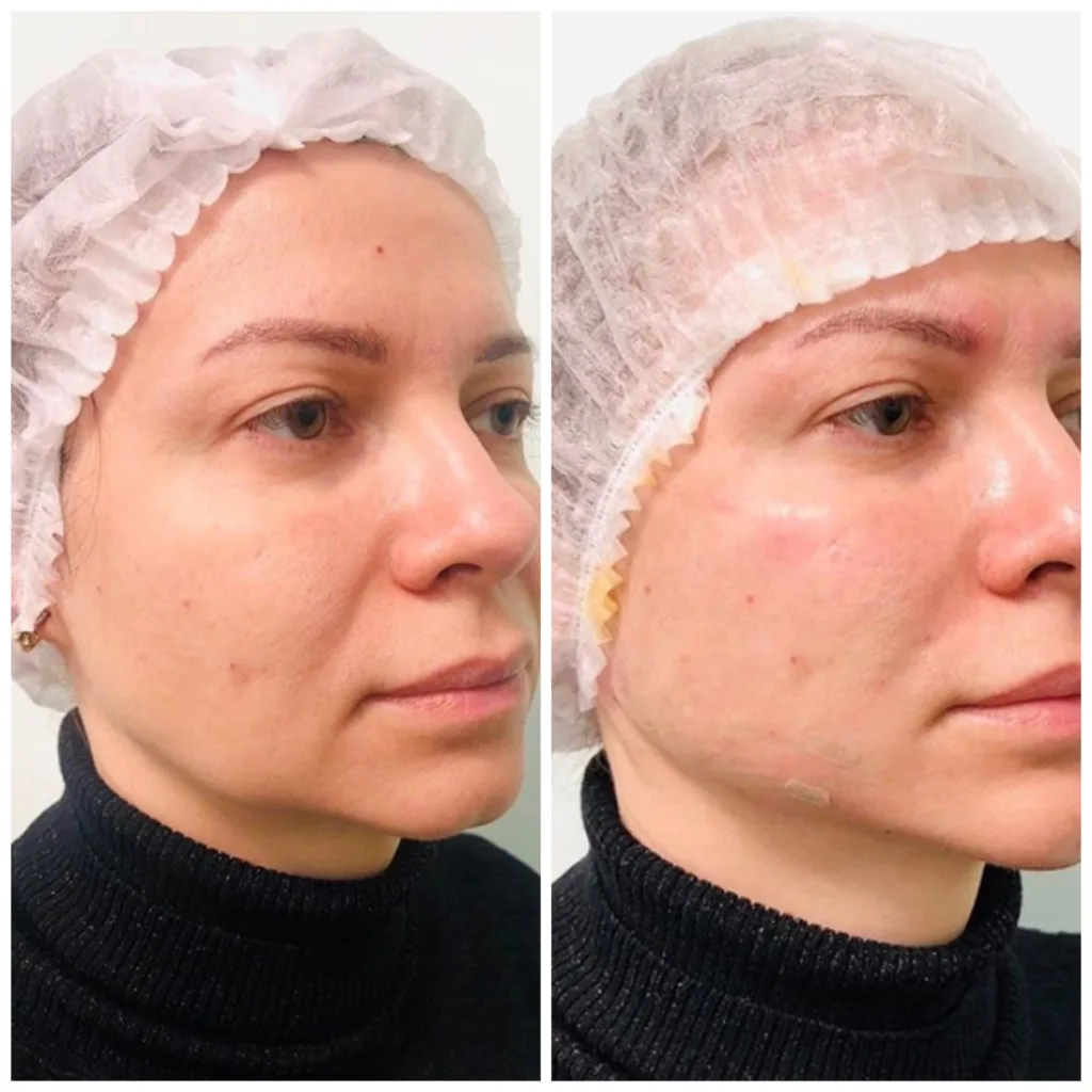 мезонити до и после фото