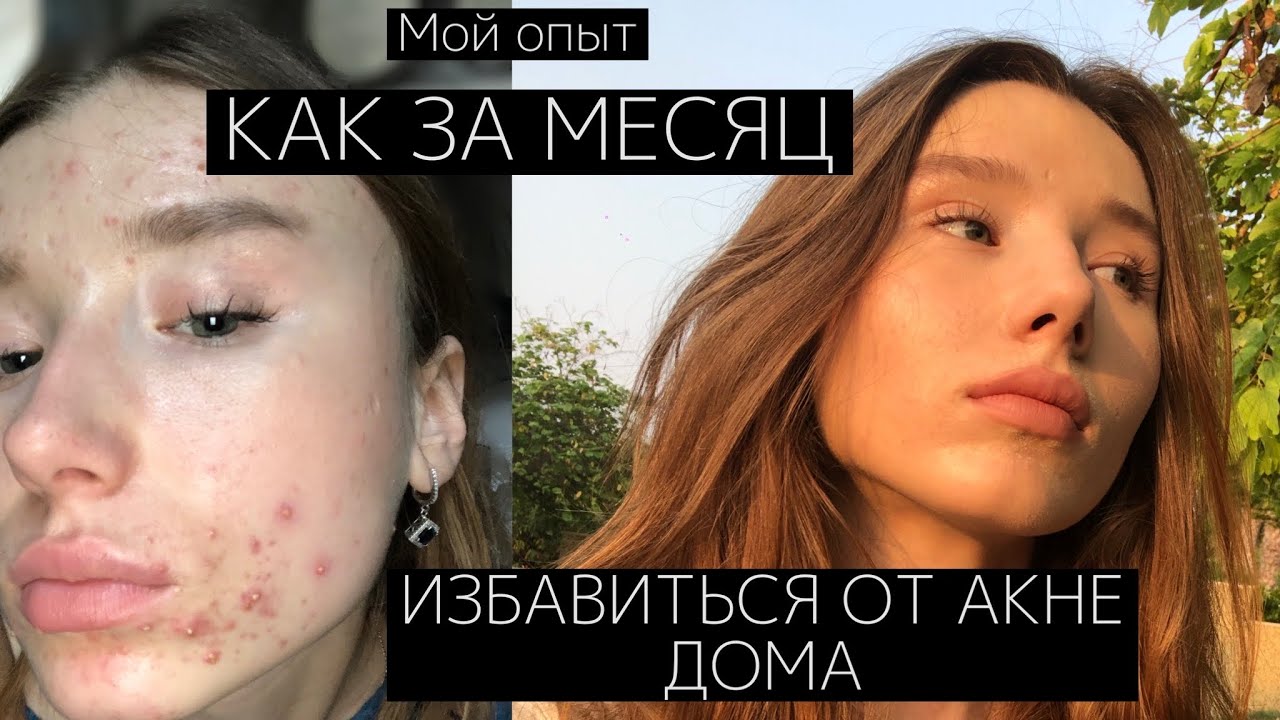Как быстро избавиться от прыщей?