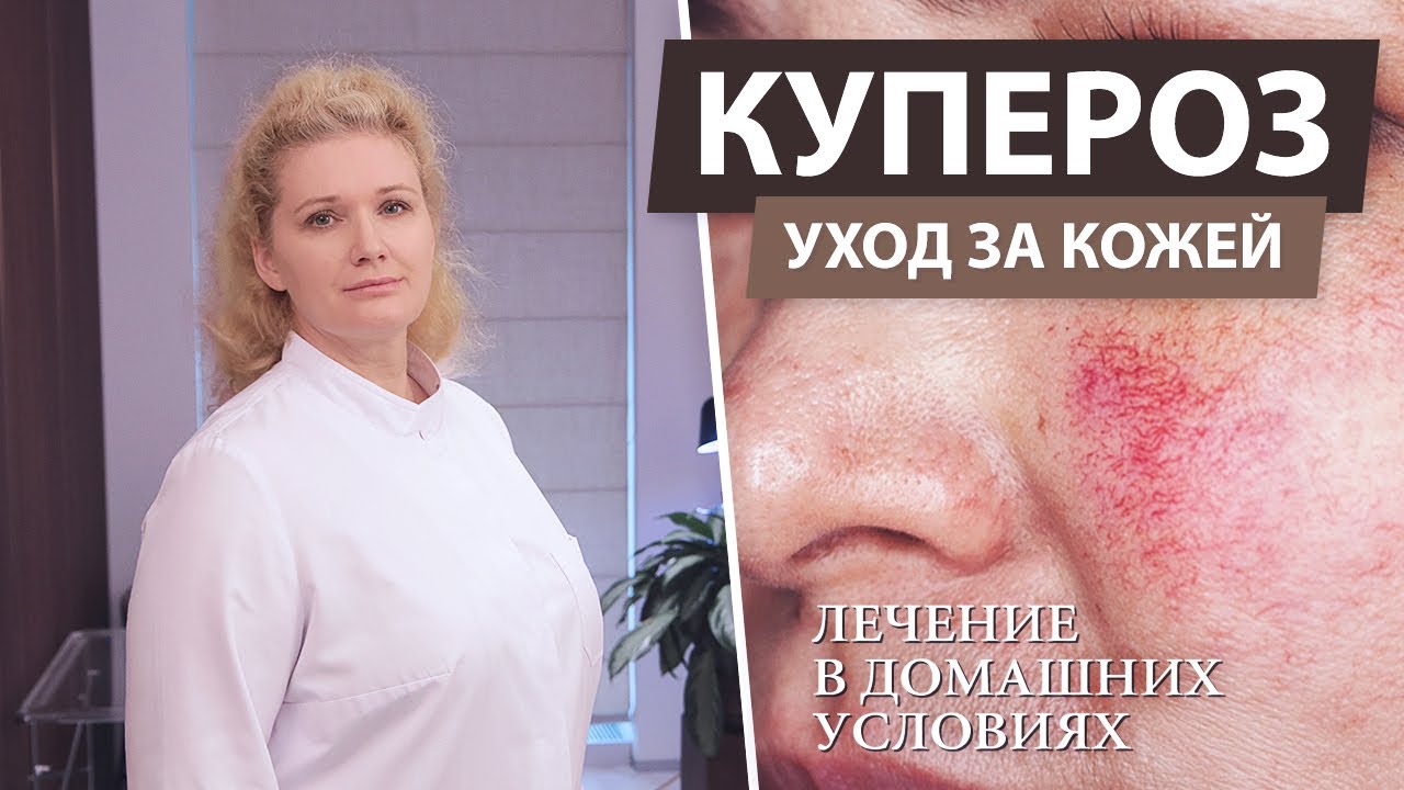 Лечение купероза на лице в домашних условиях