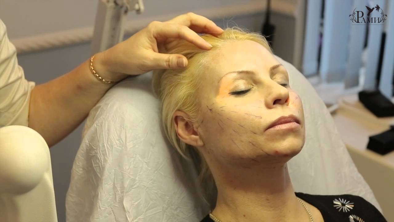 Подтяжка лица нитями Aptos