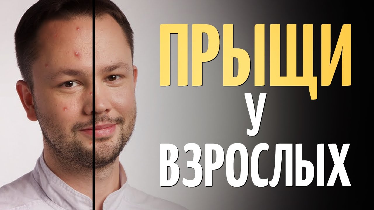 Причины акне на лице