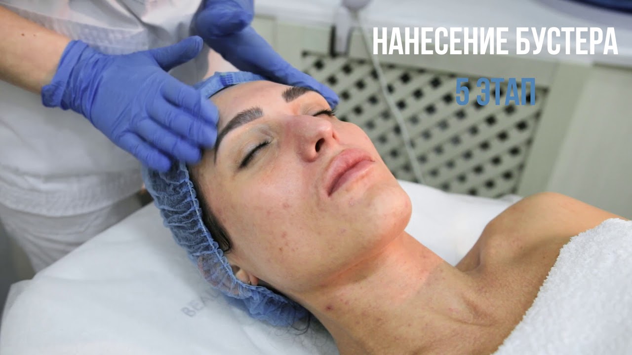 Пилинг Джесснера