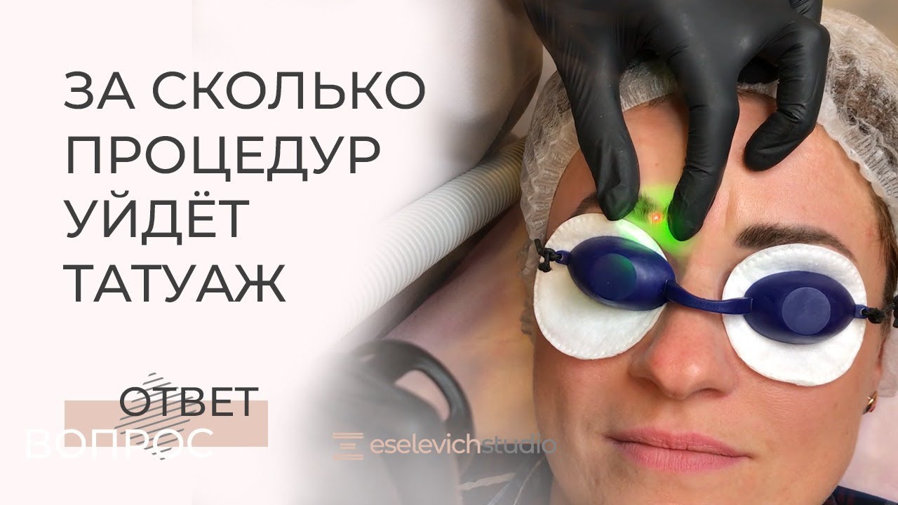 УДАЛЕНИЕ ТАТУАЖА: сколько процедур потребуется