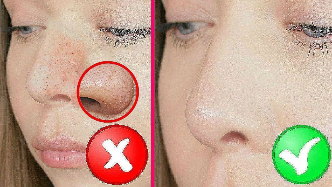 Глубокая чистка лица