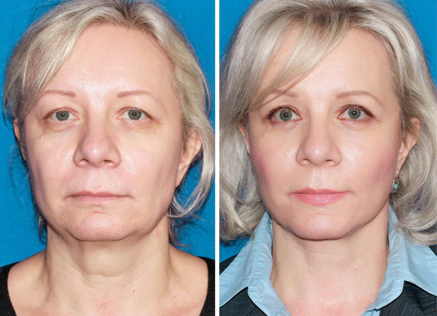 лифтинг мезонитями до и после